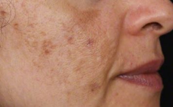 Evo kako da sa ovim jednostavnim trikom od 2 sastojka izbrišete mrlje s kože!