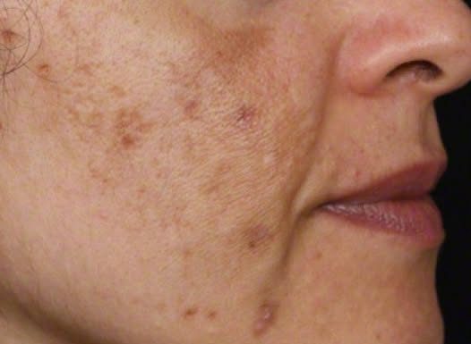 Evo kako da sa ovim jednostavnim trikom od 2 sastojka izbrišete mrlje s kože!