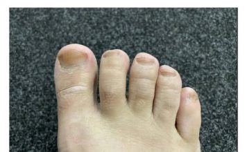 IMATE LI GLJIVICE I ŽUTE, ZADEBLJALE NOKTE: Samo namažite ovo ulje i riješit ćete problem preko noći