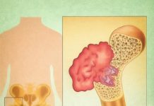 BOL U KOSTIMA, VISOK PRITISAK I TUGA: SIMPTOMI da vam u tijelu NEDOSTAJE OVAJ VAŽAN VITAMIN