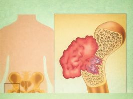 BOL U KOSTIMA, VISOK PRITISAK I TUGA: SIMPTOMI da vam u tijelu NEDOSTAJE OVAJ VAŽAN VITAMIN