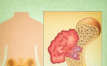 BOL U KOSTIMA, VISOK PRITISAK I TUGA: SIMPTOMI da vam u tijelu NEDOSTAJE OVAJ VAŽAN VITAMIN