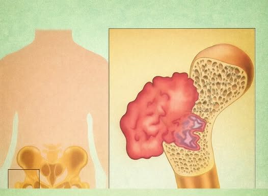 BOL U KOSTIMA, VISOK PRITISAK I TUGA: SIMPTOMI da vam u tijelu NEDOSTAJE OVAJ VAŽAN VITAMIN