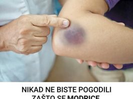 7 UZROKA MODRICA NA TIJELU, A NISU UDARCI: Evo šta može biti u pitanju