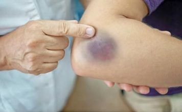 7 UZROKA MODRICA NA TIJELU, A NISU UDARCI: Evo šta može biti u pitanju