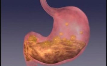 BOLJI LIJEK ZA GASTRITIS OD OVOG NE POSTOJI: Bolovi u želucu će nestati već nakon prve čaše