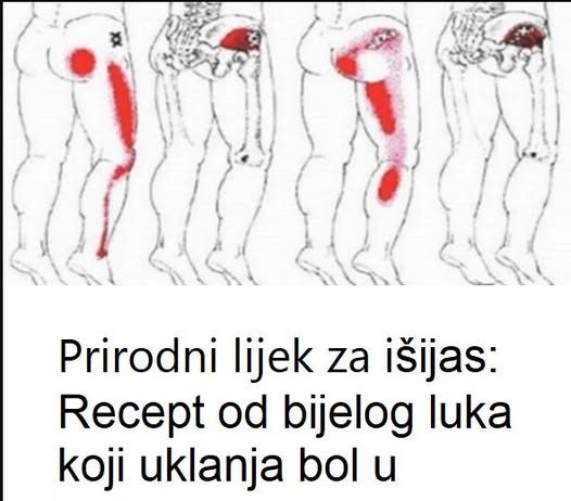Prirodni lijek za išijas: Recept od bijelog luka koji uklanja bol u leđima i nogama