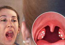 Upala grla i angina: Evo kako je izliječiti za samo jedan dan prirodnim putem