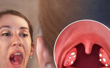 Upala grla i angina: Evo kako je izliječiti za samo jedan dan prirodnim putem