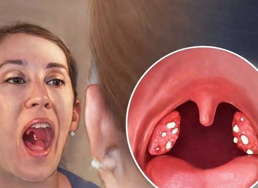 Upala grla i angina: Evo kako je izliječiti za samo jedan dan prirodnim putem