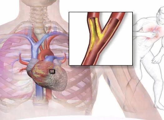 Probada vas u grudima, ili vam preskače srce: Izliječite sve probleme sa srcem, čak i anginu pektoris! – Probajte ovo odmah!