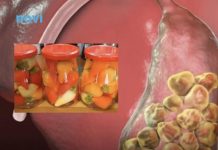 Hrana koja najteže pada osobama sa kamenom u žuči: Ne bi smjeli da je okuse