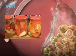 Hrana koja najteže pada osobama sa kamenom u žuči: Ne bi smjeli da je okuse