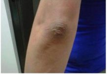 OVA PROMJENA NA LAKTU GOVORI DA SA VAŠIM ORGANIZMOM NEŠTO NIJE U REDU: EVO O KAKVOJ BOLESTI SE RADI