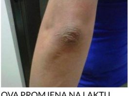 OVA PROMJENA NA LAKTU GOVORI DA SA VAŠIM ORGANIZMOM NEŠTO NIJE U REDU: EVO O KAKVOJ BOLESTI SE RADI