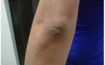 OVA PROMJENA NA LAKTU GOVORI DA SA VAŠIM ORGANIZMOM NEŠTO NIJE U REDU: EVO O KAKVOJ BOLESTI SE RADI