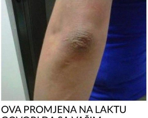OVA PROMJENA NA LAKTU GOVORI DA SA VAŠIM ORGANIZMOM NEŠTO NIJE U REDU: EVO O KAKVOJ BOLESTI SE RADI