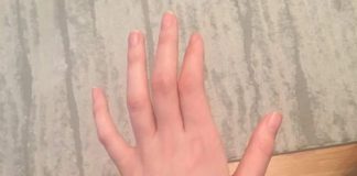 OBAVEZNO OBRATITE PAŽNJU: Ako vam trnu prsti, to može da znači nekoliko stvari, a ovo je uzrok