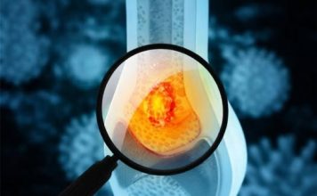 Tihi simptomi raka kostiju: Kakav bol i u kom delu tela može da bude alarm upozorenja