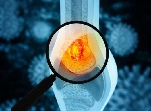 Tihi simptomi raka kostiju: Kakav bol i u kom delu tela može da bude alarm upozorenja