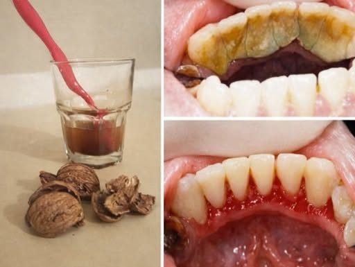 Uklonite zubni kamenac kod kuće prirodnim putem