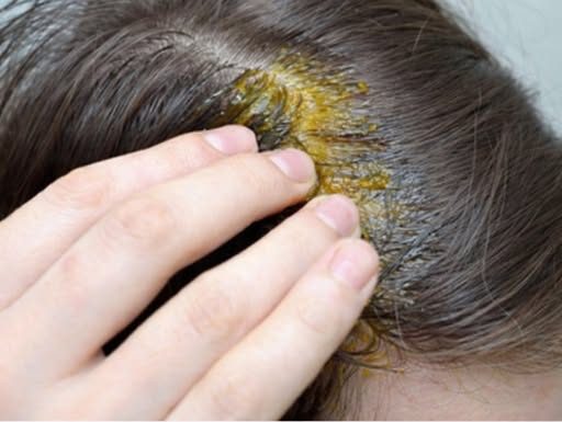 BUBULJICE NA GLAVI SU SVE ČEŠĆI PROBLEM: Ni slučajno ih ne istiskujte, evo zašto se javljaju I ŠTA TREBATE URADITI DA NESTANU