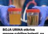 BOJA URINA otkriva mnoge ozbiljne bolesti, pa čak i one NAJTEŽE – Ovo je RAZLOG mutne mokraće!