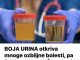 BOJA URINA otkriva mnoge ozbiljne bolesti, pa čak i one NAJTEŽE – Ovo je RAZLOG mutne mokraće!