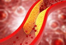 1 ZNAK DOK HODAMO UKAZUJE NA POVIŠEN HOLESTEROL