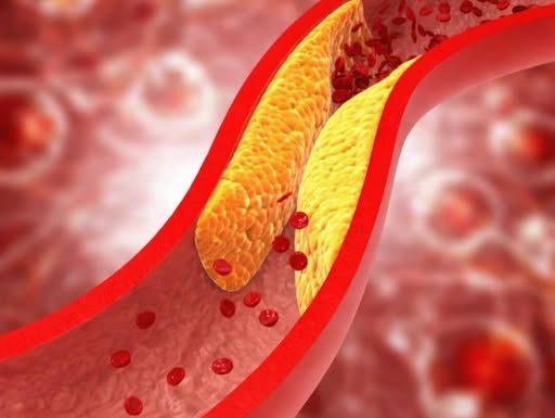 1 ZNAK DOK HODAMO UKAZUJE NA POVIŠEN HOLESTEROL