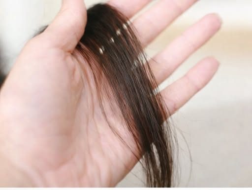 Evo šta kosa otkriva o našem zdravlju: Bolesna štitnjača ili anemija…