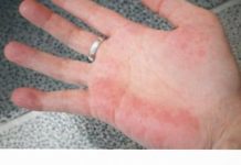 AKO IMATE CRVENE DLANOVE, ODMAH IZVADITE KRV: Ovaj simptom upozorava da vam jedan organ otkazuje