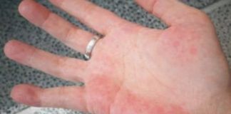 AKO IMATE CRVENE DLANOVE, ODMAH IZVADITE KRV: Ovaj simptom upozorava da vam jedan organ otkazuje