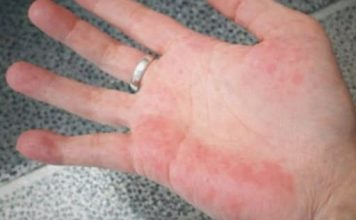 AKO IMATE CRVENE DLANOVE, ODMAH IZVADITE KRV: Ovaj simptom upozorava da vam jedan organ otkazuje