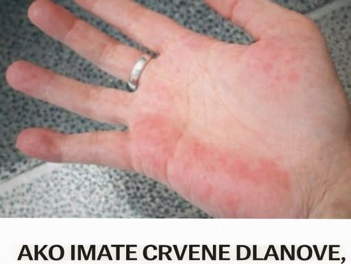AKO IMATE CRVENE DLANOVE, ODMAH IZVADITE KRV: Ovaj simptom upozorava da vam jedan organ otkazuje