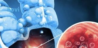 Tihi signali opake bolesti: Ovo su 4 znaka raka debelog crijeva koje tijelo šalje mjesecima prije