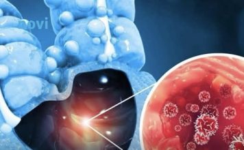 Tihi signali opake bolesti: Ovo su 4 znaka raka debelog crijeva koje tijelo šalje mjesecima prije