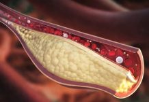 Ovo je najzdraviji prirodni napitak: Zbogom lošem holesterolu i začepljenim arterijama! (RECEPT)