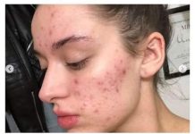 AKNE, SUHA KOŽA I OPADANJE KOSE: Ako imate OVE SIMPTOME fali vam važan mineral – evo koje namirnice OBAVEZNO da jedete