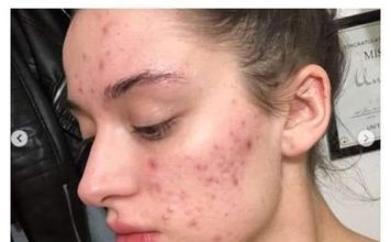 AKNE, SUHA KOŽA I OPADANJE KOSE: Ako imate OVE SIMPTOME fali vam važan mineral – evo koje namirnice OBAVEZNO da jedete