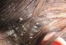 Imate li problema sa peruti? Ovo je najefikasnije i prirodno rješenje za kojim su svi poludjeli!