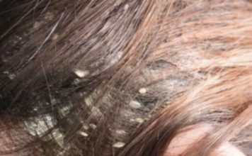 Imate li problema sa peruti? Ovo je najefikasnije i prirodno rješenje za kojim su svi poludjeli!