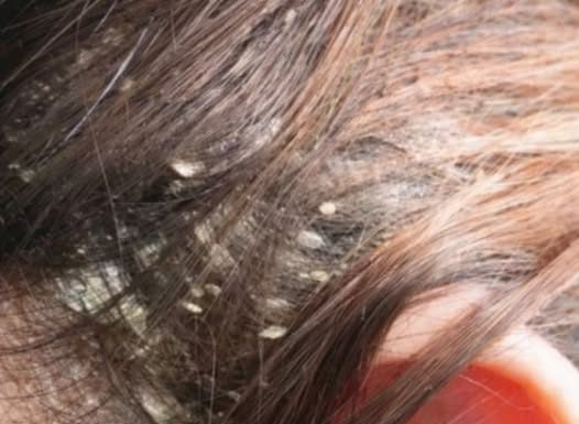 Imate li problema sa peruti? Ovo je najefikasnije i prirodno rješenje za kojim su svi poludjeli!