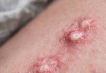 Akne ili nešto drugo? Šta je gnojni hidradenitis i kako se tretira