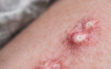 Akne ili nešto drugo? Šta je gnojni hidradenitis i kako se tretira