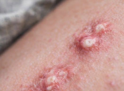 Akne ili nešto drugo? Šta je gnojni hidradenitis i kako se tretira