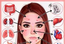 Mjesto prištića otkriva uzrok: Muči li vas probava ili hormoni