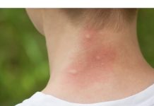 UJEO VAS JE KOMARAC, SAMO NAMAŽITE OVO: Svrab nestaje u sekundi, RIJEŠITE SE MUKE