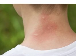 UJEO VAS JE KOMARAC, SAMO NAMAŽITE OVO: Svrab nestaje u sekundi, RIJEŠITE SE MUKE