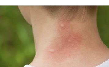 UJEO VAS JE KOMARAC, SAMO NAMAŽITE OVO: Svrab nestaje u sekundi, RIJEŠITE SE MUKE